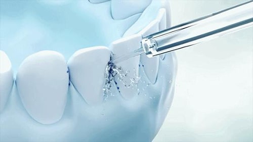 Beneficios de los hilo dental para los usuarios de aparatos ortopédicos